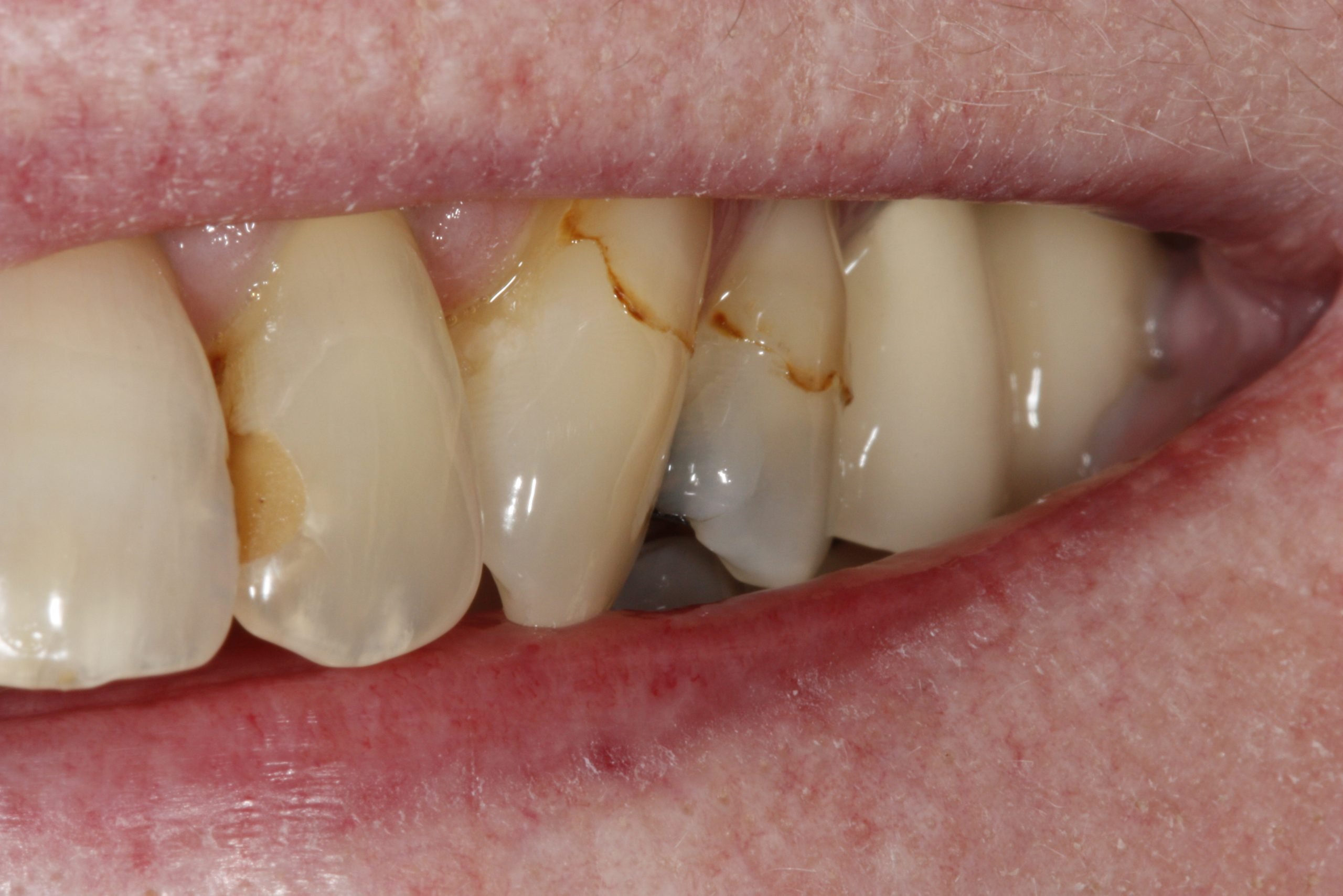 Stains On Teeth: Can They Be Removed?
