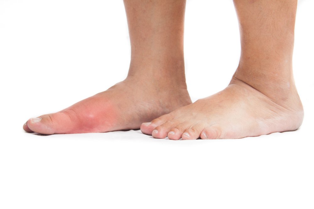 Suffering from Gout?