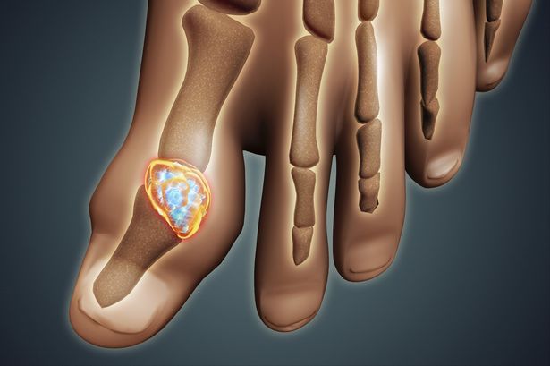 Why Is Gout On The Increase?