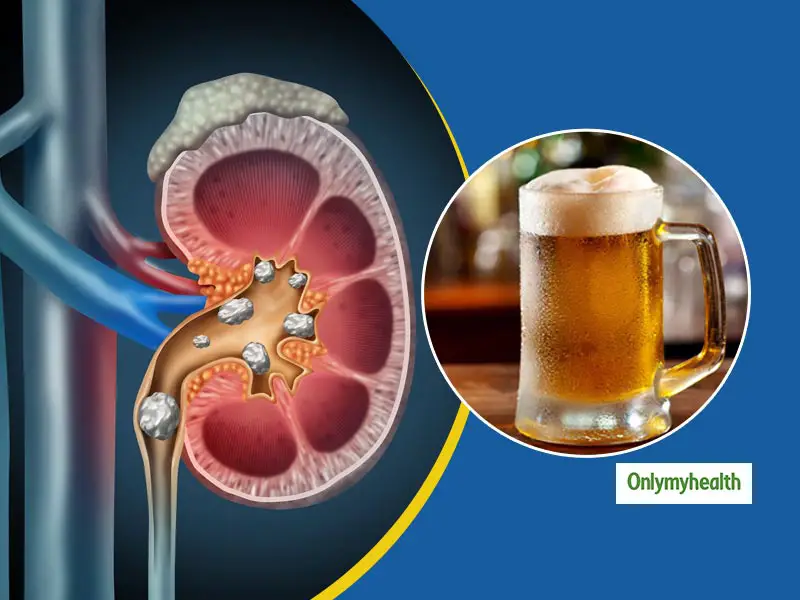 Will Drinking Cause Kidney Stones